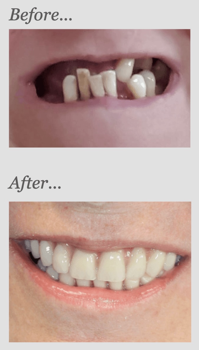 All-on-4 case, before and after: failing teeth replaced with fixed full-arch implant teeth
