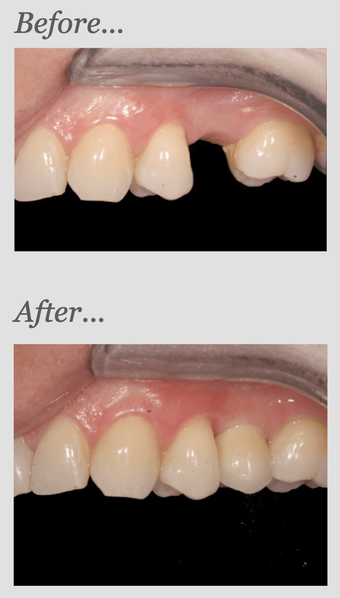 Single tooth implant case, before and after: missing upper premolar replaced with an implant crown